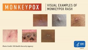 Local health experts explain Monkeypox